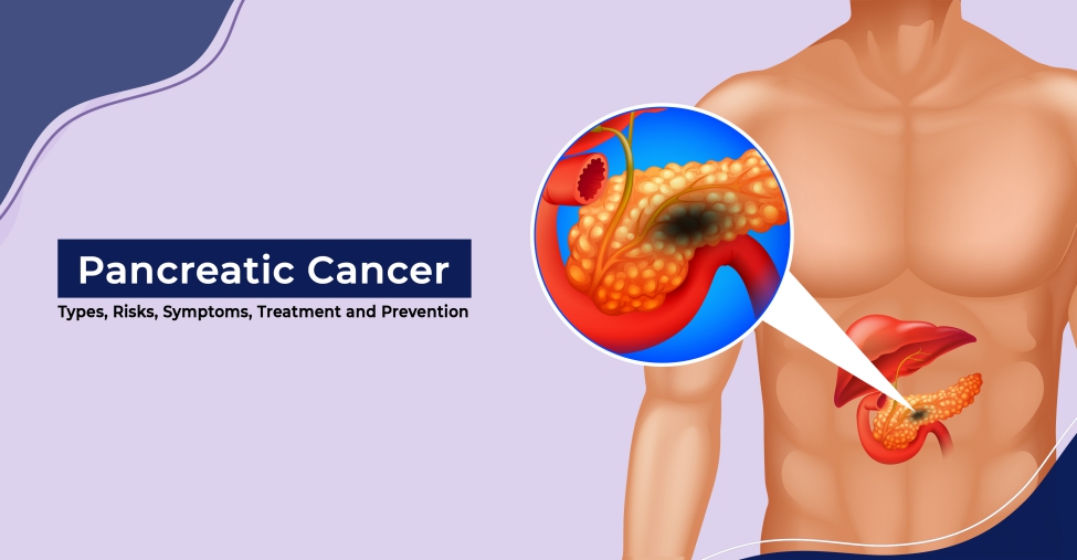 Diagnosis and Treatment for Pancreatic Cancer